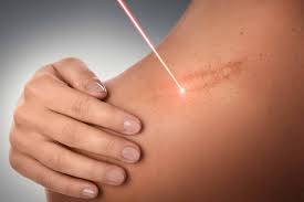 Các biện pháp phòng ngừa sẹo lồi